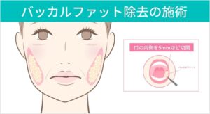 バッカルファット除去の施術説明図