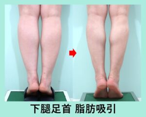 ふくらはぎ脂肪吸引のビフォーアフター