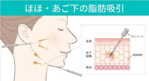 頬と顎下の脂肪吸引を解説する図