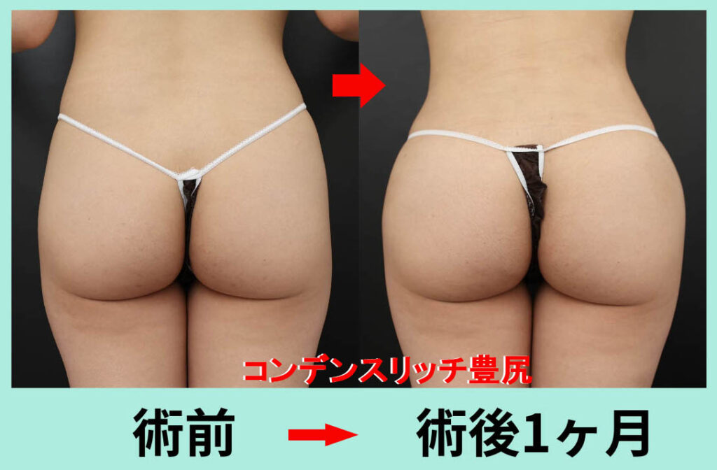 autologous gluteal fat grafting