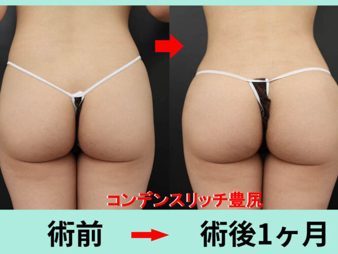 ブラジリアンバットリフト　CRF脂肪注入　豊尻