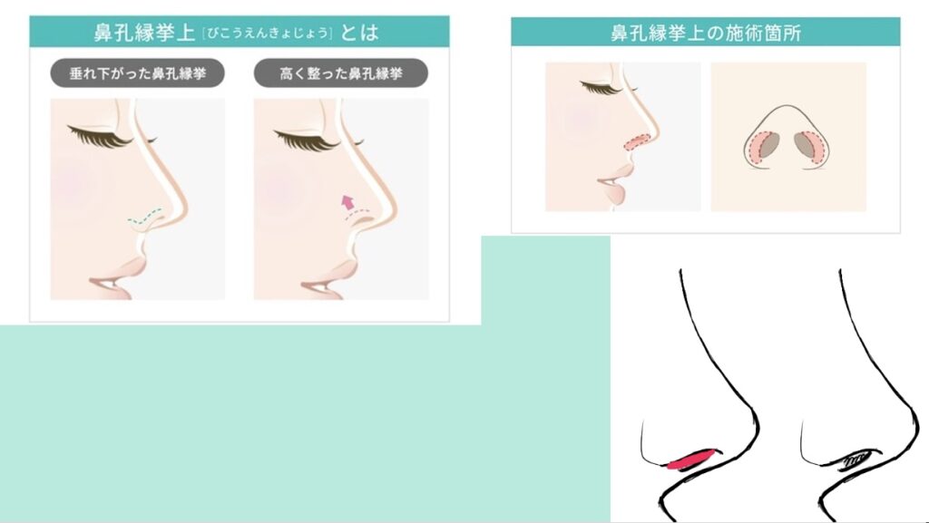 『【他院修正】鼻先の丸みと高さ低下を改善 鼻孔縁挙上で“鼻の穴の見え方”まで整えた修正鼻整形』の画像
