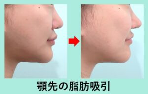 女性の顔の顎下脂肪吸引前後比較