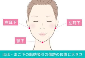 顔の脂肪吸引の傷跡の位置を示す図