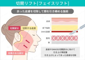 フェイスリフトの切開と皮膚組織の構造図