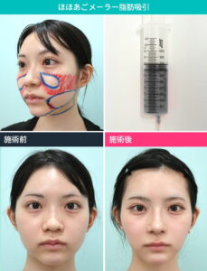 脂肪吸引の術前術後の比較と施術過程