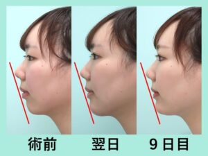 女性の顎の術前 翌日 9日目の比較