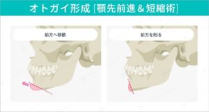 オトガイ形成術による顎の形状変化のイラスト