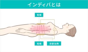 インディバ深部加熱の施術イメージ
