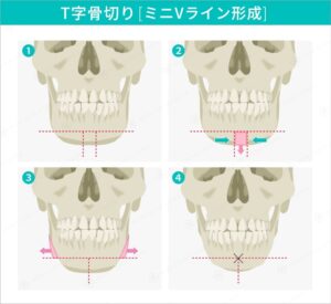 下顎骨切り術ミニVライン形成のイラスト