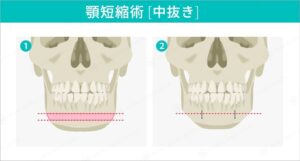 下顎骨の短縮手術前後の比較