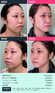 骨切りと脂肪吸引のビフォーアフター