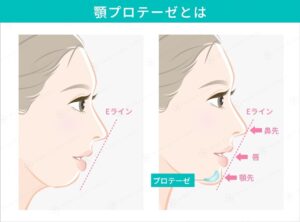 顎プロテーゼによるEラインの変化の比較