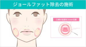 ジョールファット除去の施術説明図