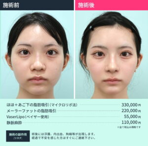 小顔治療のビフォーアフターと施術料金（正面）1