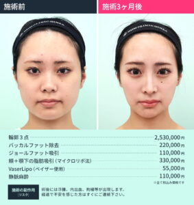 小顔治療のビフォーアフターと施術料金（正面）2