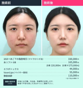 小顔治療のビフォーアフターと施術料金（正面）3
