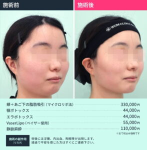 小顔治療のビフォーアフターと施術料金（正面）4