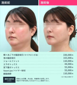 小顔治療のビフォーアフターと施術料金（正面）5