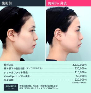 小顔治療のビフォーアフターと施術料金（横顔）1