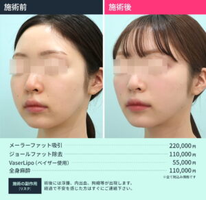 小顔治療のビフォーアフターと施術料金（横顔）3