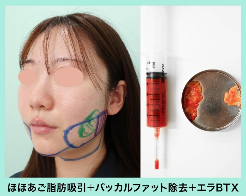『脂肪吸引とバッカルファットの組み合わせ治療で左右差を調整する』の画像