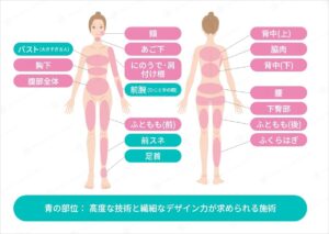 脂肪吸引が可能な体の部位と注意点を説明する図