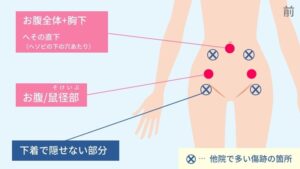 腹部脂肪吸引の傷跡の位置