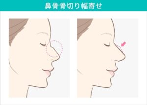 鼻骨骨切り幅寄せの術前術後の比較