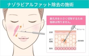 ナゾラビアルファット除去の施術説明図