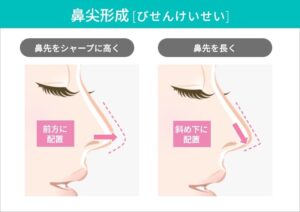 鼻形成術における鼻先の変化の比較