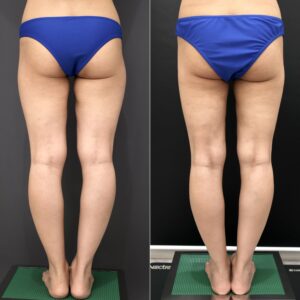 『【30代・授乳後バスト】太もも脂肪吸引＋CRF豊胸で自然なボリューム改善を』の画像