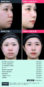 整形手術のビフォーアフターと料金表01