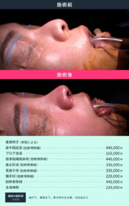 整形手術のビフォーアフターと料金表03