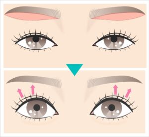 眉下切開の範囲と術後のイラスト