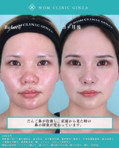 鼻の皮膚が厚い症例のビフォーアフター01
