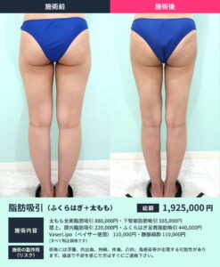 太ももとふくらはぎの脂肪吸引のビフォーアフター