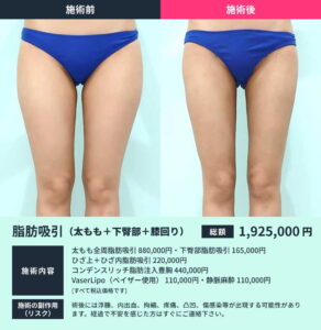太ももの脂肪吸引のビフォーアフター