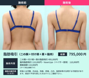 二の腕の脂肪吸引のビフォーアフター