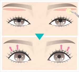 目の上切開と脂肪除去で目元が引き締まる様子
