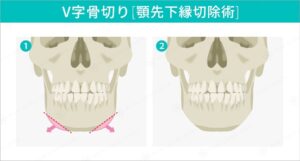 V字骨切りによる顎の整形術の比較図
