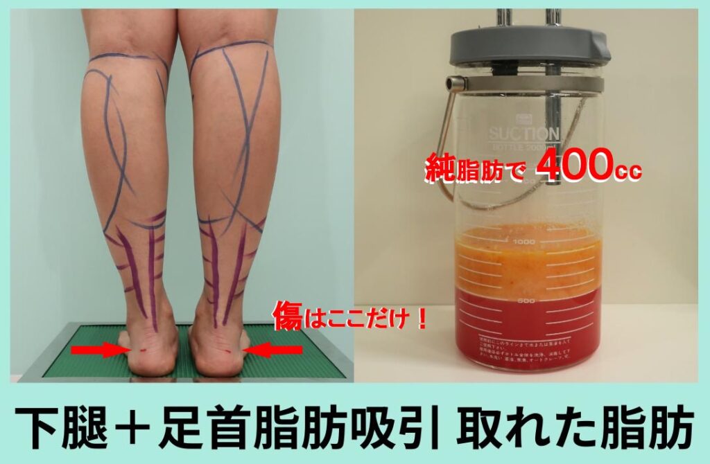 ふくらはぎ吸引のデザインと脂肪