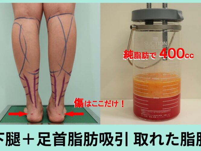 ふくらはぎ吸引のデザインと脂肪