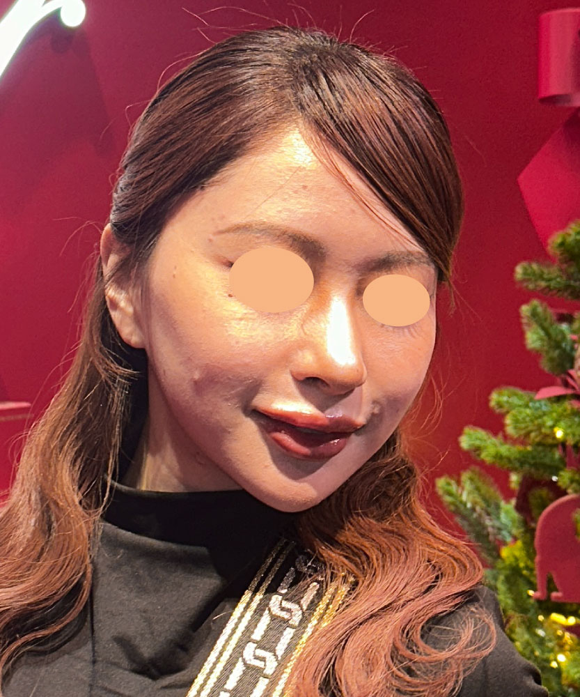 小顔の匠だからできる修正技術 BEFORE写真