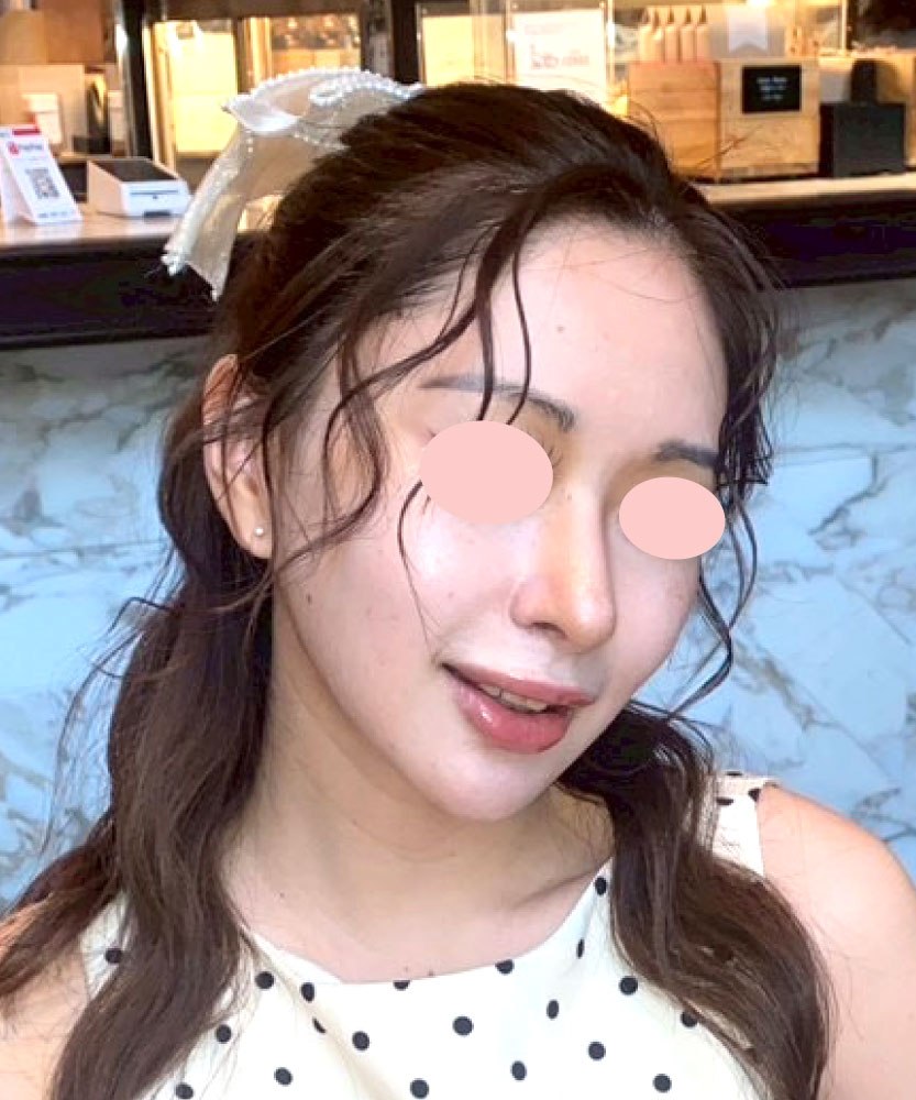 小顔の匠だからできる修正技術 AFTER写真