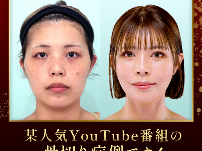 【リベンジハウス】20509 輪郭3点(Vライン形成・オトガイT字骨切り・頬骨L字骨切り)、頬・顎下の脂肪吸引・頬コケ・額こめかみ脂肪注入