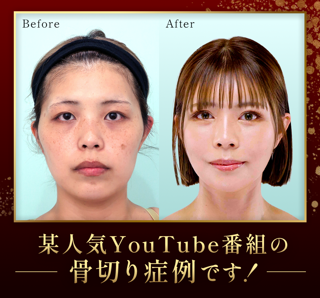 【リベンジハウス】20509 輪郭3点(Vライン形成・オトガイT字骨切り・頬骨L字骨切り)、頬・顎下の脂肪吸引・頬コケ・額こめかみ脂肪注入