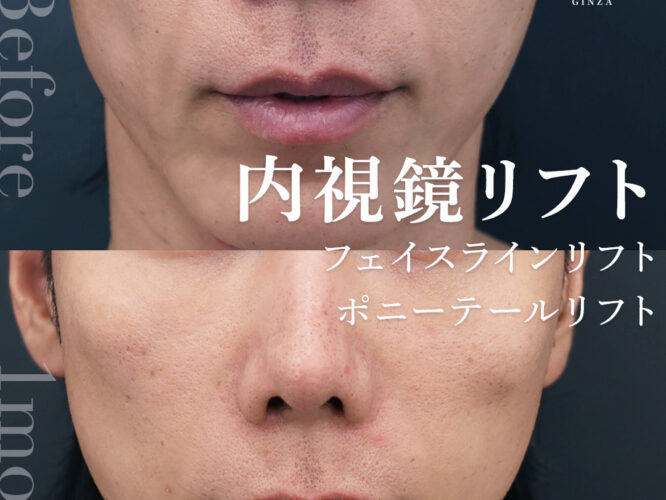 内視鏡フェイスリフト　内視鏡ポニーテールリフト　フェイスラインリフト