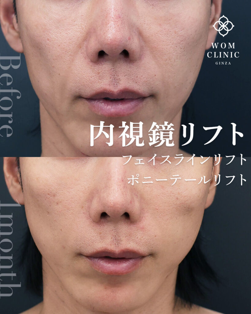 内視鏡フェイスリフト 内視鏡ポニーテールリフト フェイスラインリフト
