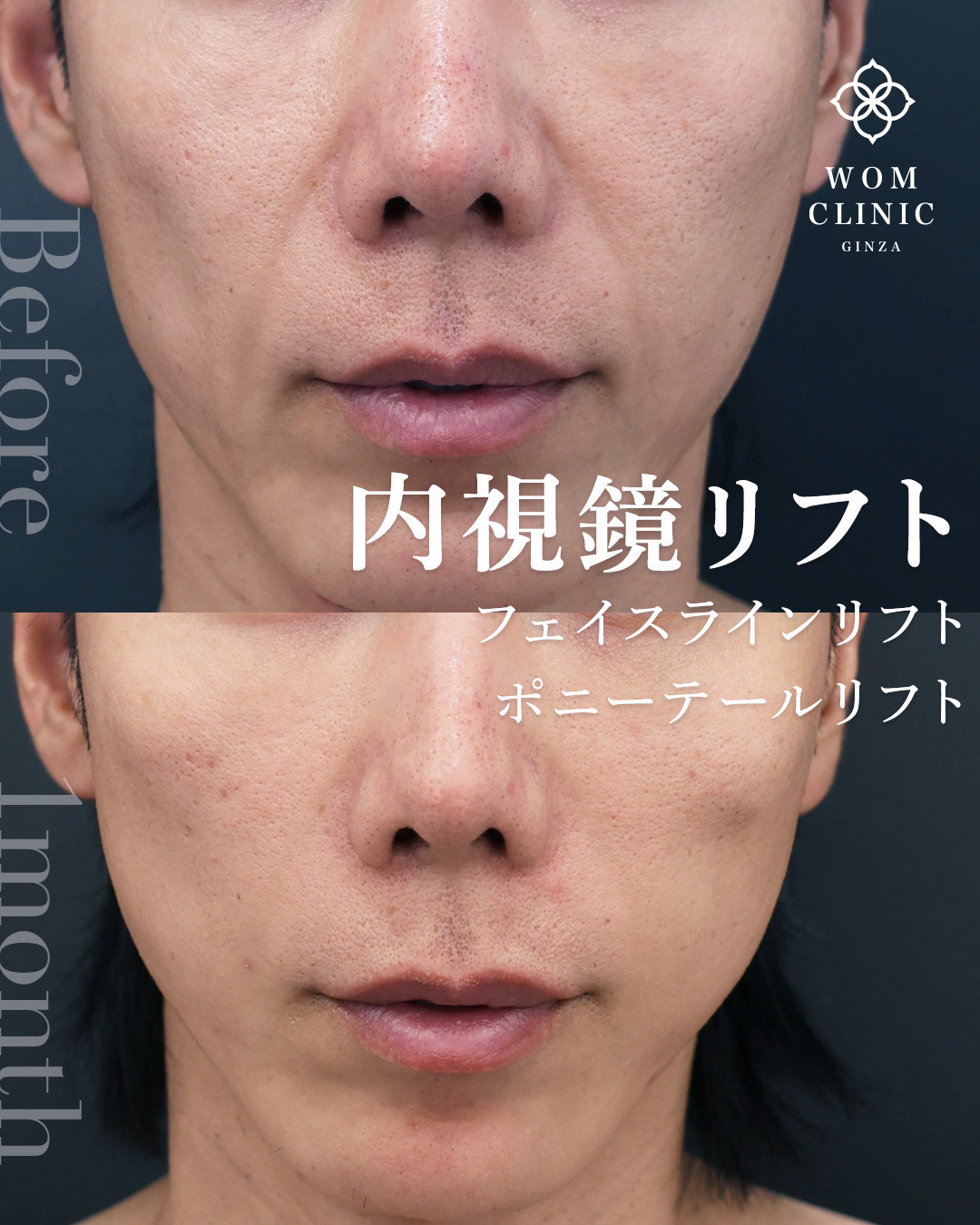 内視鏡フェイスリフト　内視鏡ポニーテールリフト　フェイスラインリフト